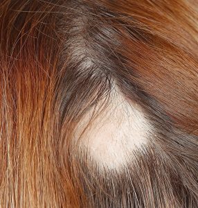 Ein typisches Anzeichen von kreisrundem Haarausfall sind runde, kahle Stellen am Kopf.