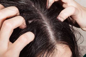 Trockene Kopfhaut kann durch Flüssigkeitsmangel, falsche Pflege und weitere Ursachen ausgelöst werden.
