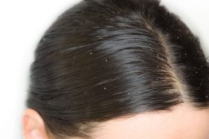 Übermäßiger Gebrauch von Kopfhaut-Peelings kann Beschwerden verstärken.
